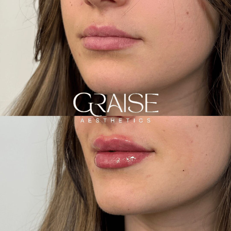dermal filler